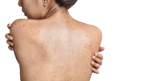 masalah jerawat badan curio spa